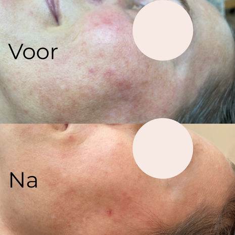 Pigment en huidverbetering