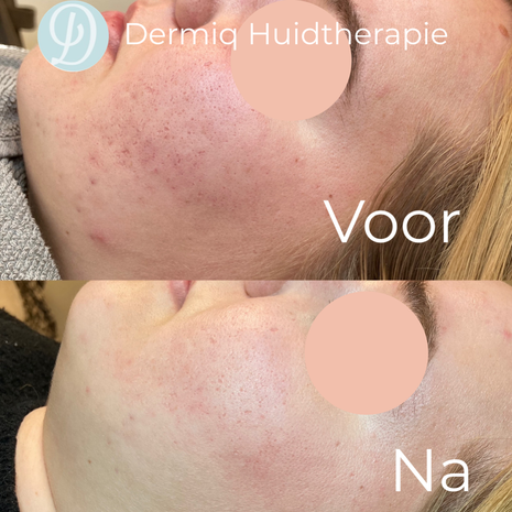 Acne littekens