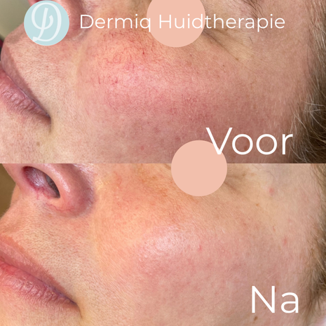 Couperose behandeling