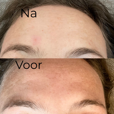 Pigment en huidverbetering