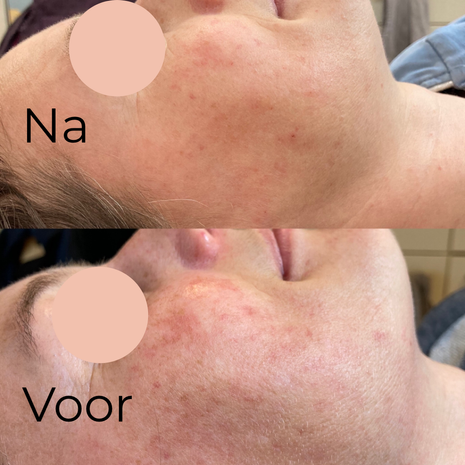 Pigment en huidverbetering