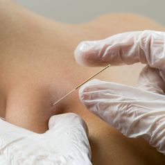 dryneedling
