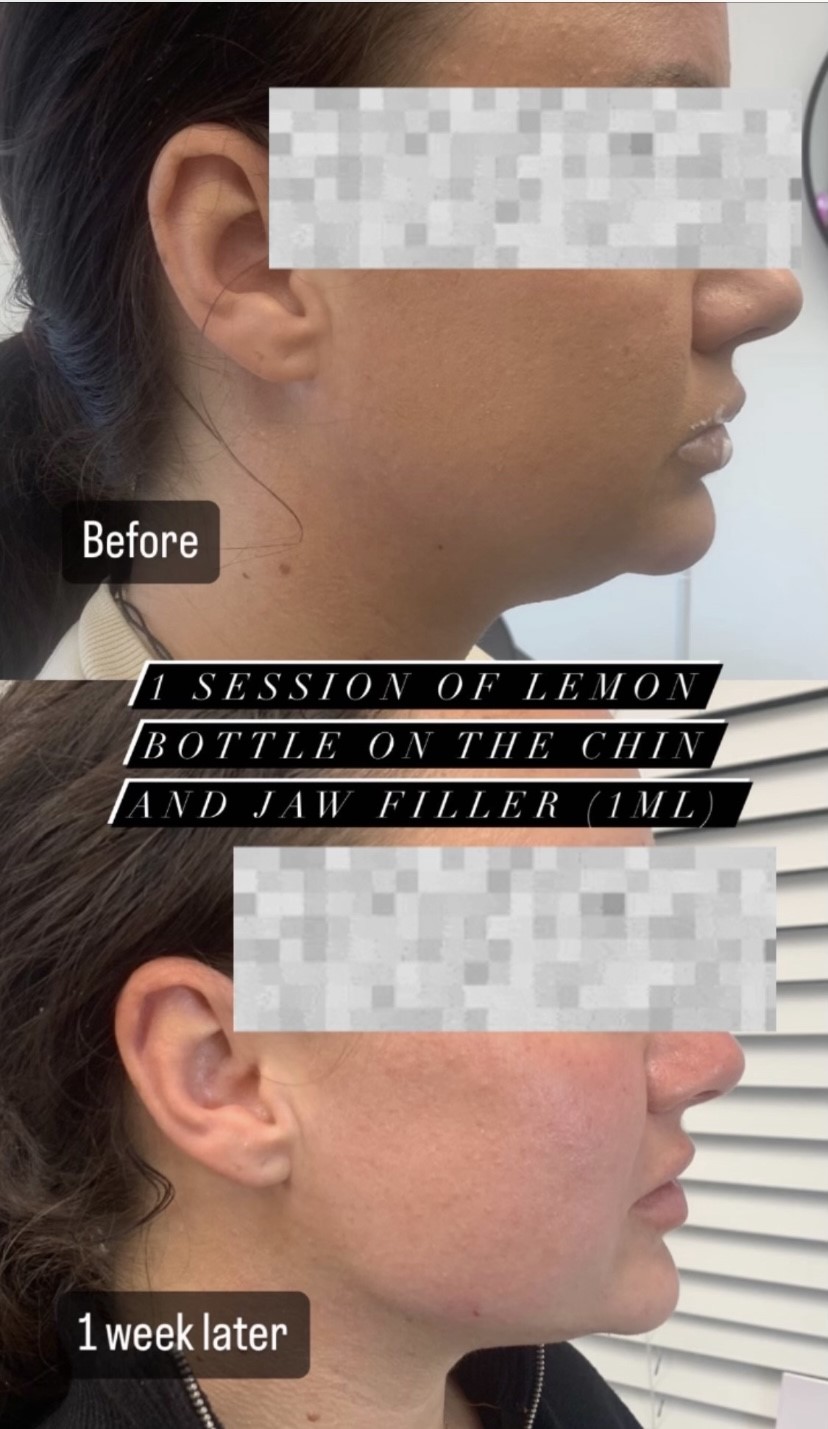 Lemon bottle fat dissolving double chin