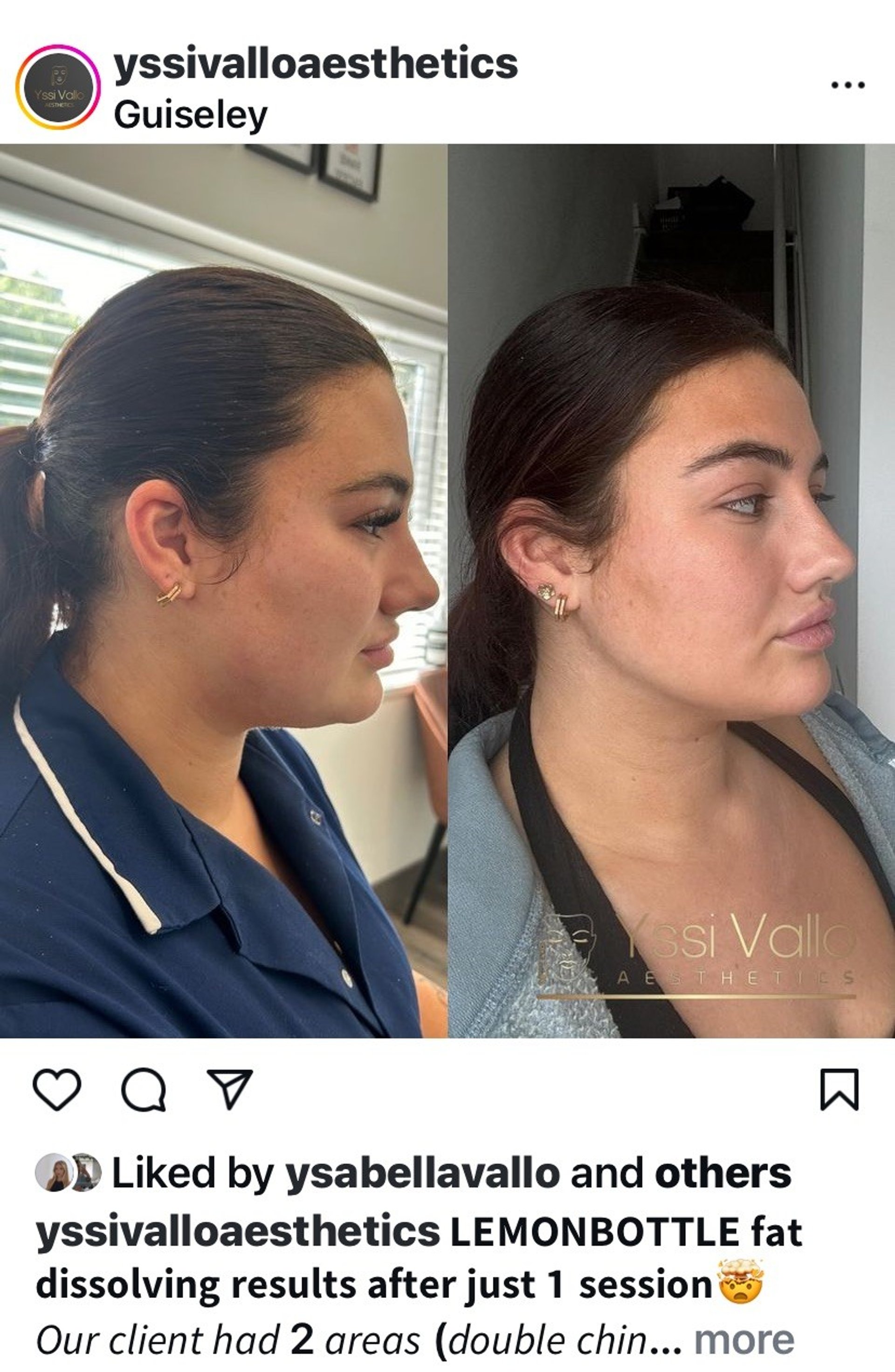 lemon bottle fat dissolving reviews double chin Lemon bottle fat dissolving pay day offer (chin only) £100