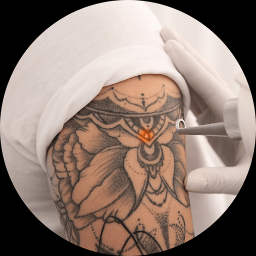 TATTOO VERWIJDEREN
