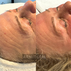 Huidverbetering acne antiaging rosacea hyperpigmentatie pigmentvlekken
