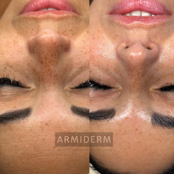 Huidverbetering acne antiaging rosacea hyperpigmentatie pigmentvlekken
