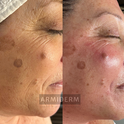 Huidverbetering acne antiaging rosacea hyperpigmentatie pigmentvlekken