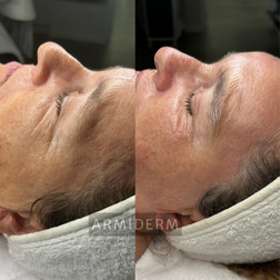 Huidverbetering acne antiaging rosacea hyperpigmentatie pigmentvlekken
