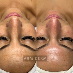 Huidverbetering acne antiaging rosacea hyperpigmentatie pigmentvlekken