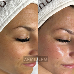 Huidverbetering acne antiaging rosacea hyperpigmentatie pigmentvlekken