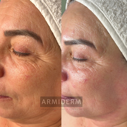 Huidverbetering acne antiaging rosacea hyperpigmentatie pigmentvlekken