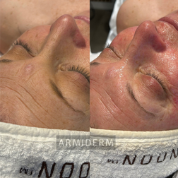 Huidverbetering acne antiaging rosacea hyperpigmentatie pigmentvlekken