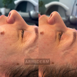 Huidverbetering acne antiaging rosacea hyperpigmentatie pigmentvlekken