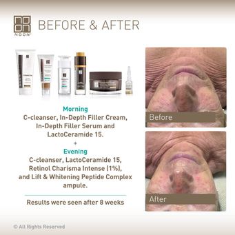 Noon Aesthetics Before After Armiderm