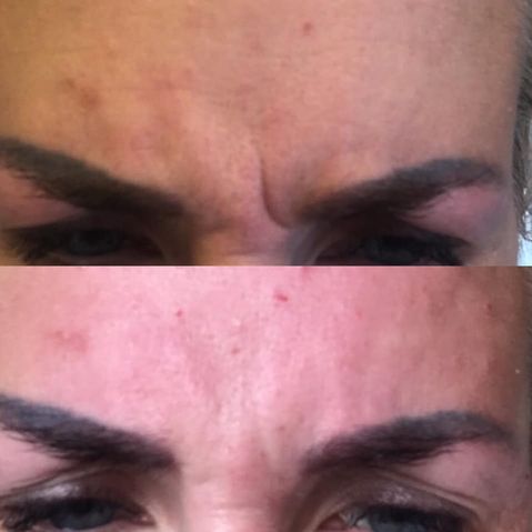 Glabella / sinnarynke