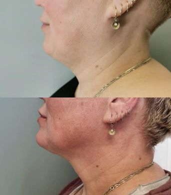 JAW AND CHIN