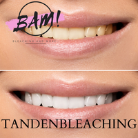 tandenbleaching