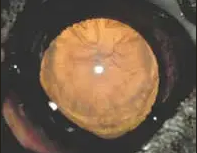 beginnender Katarakt