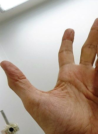 maladie de Dupuytren
retraction  D4