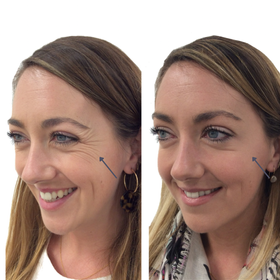 Crows Feet Botox Dermal Fillers