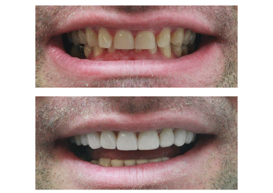 Composite Bonding Harley Street