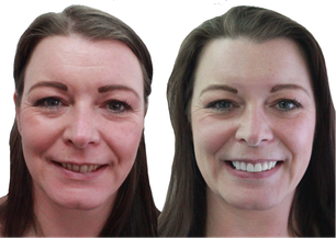 Composite Bonding London