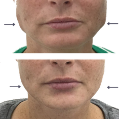Jaw Slimming Botox Dermal Fillers