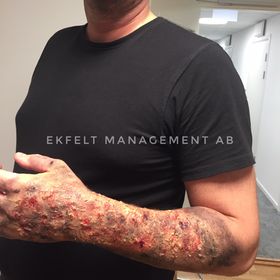 Brandskada arm