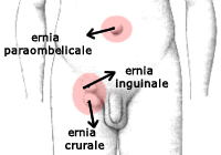 Ernie addominali