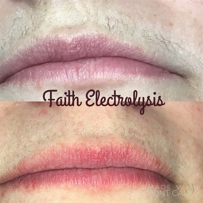 Upper lip. Results after 2 treatments.