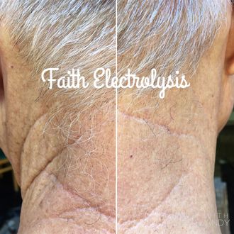 Back of the neck. Right side: the results 3  months after 1 full treatment.