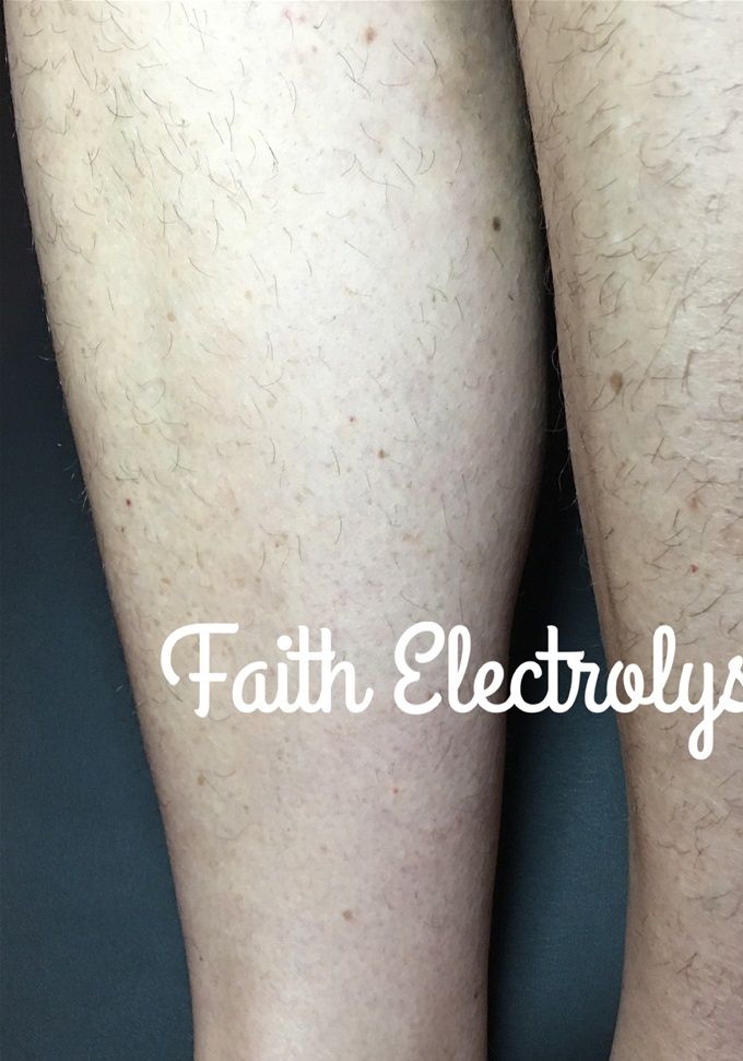 Right leg, results 5 months after one full treatment. The left leg was never touched!!