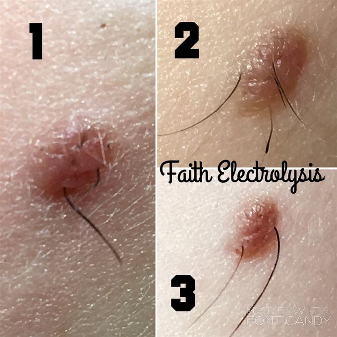 This is a mole on the face after 3 treatments. If you zoom in, you can see that it started out with 7 hairs in it!!