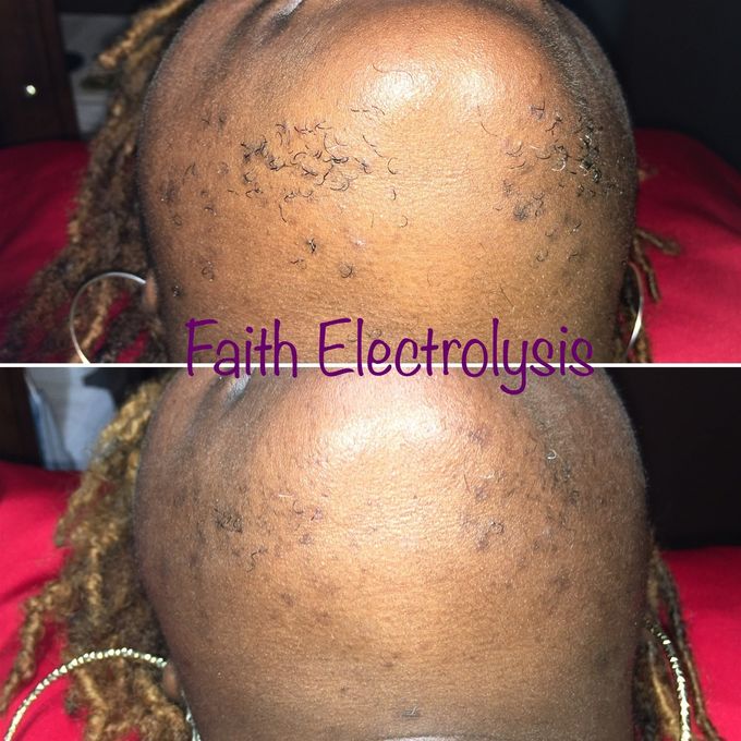 Chin & neck. Results after 6 weeks of treatments.