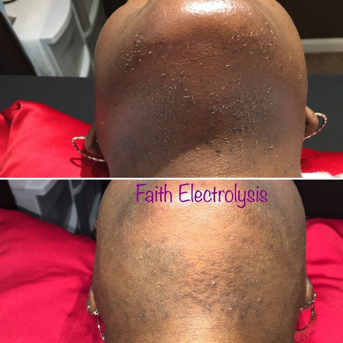 Chin & neck. Results after 3 months of treatments.