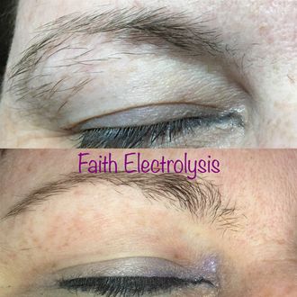 Eyelids. Results after 3 treatments.