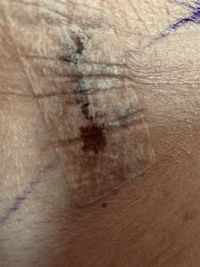 Skildvagtlymfeknude 2.