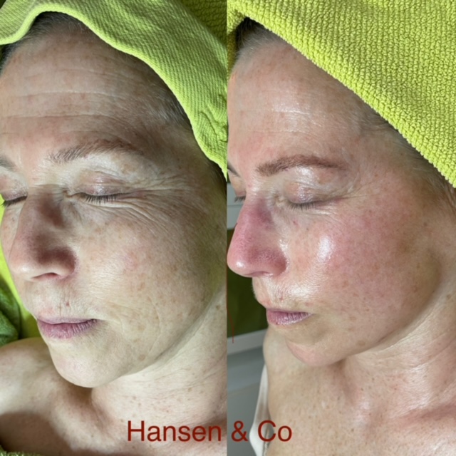 Hansen & Co FE Mesoduo