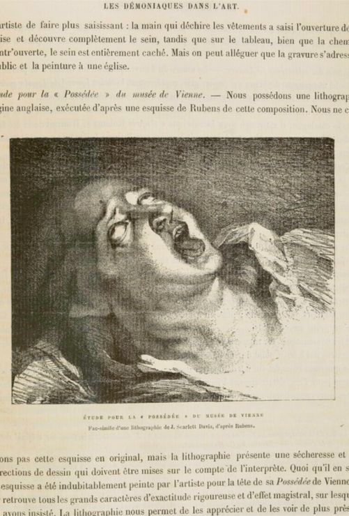charcot11