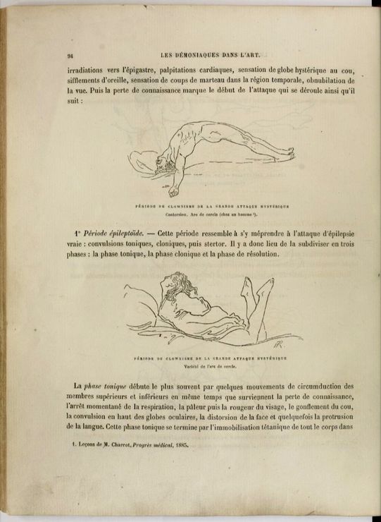 charcot13