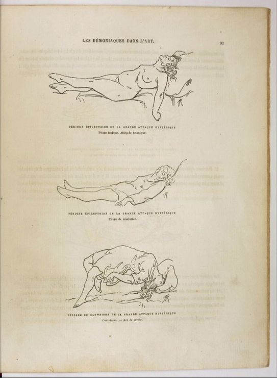 charcot9