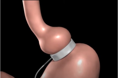 Hypnotic Gastric Band -  Pre 1 of 3