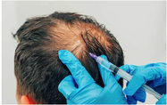 Trapianto capelli in Albania