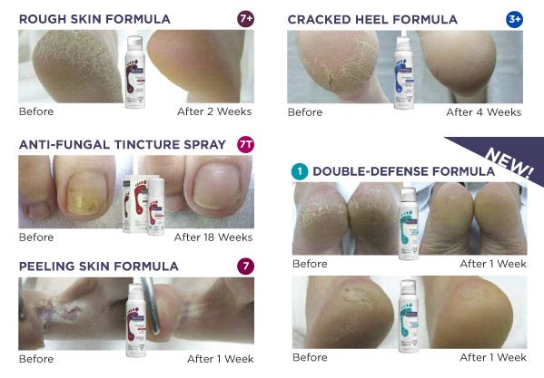 Wij werken met Footlogix!
Footlogix is de eerste en enigste Pediceutical- voetverzorgingslijn ter wereld.

Voordelen Footlogix:
- unieke formules op basis van mousse zijn licht, sluiten de poriën niet af en laten geen vettige laag achter.
- De Producten werken snel: een fantastisch resultaat in slecht 24u
- Gebruiksvriendelijk: de producten worden snel geabsorbeerd door de huid en maken de voeten weer gezond.
- Veilig voor alle huidtypes, ook voor ouderen en diabetici
- Aanbrengen .... en klaar!