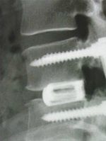 Arthrodèse telle que j'ai actuellement