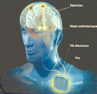Stimulation cérébrale électrique