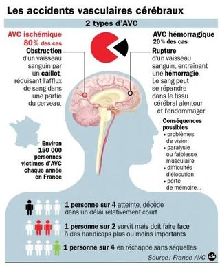 Les accidents vasculaires cérébraux