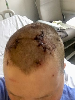 Ma tête après la stimulation cérébrale profonde