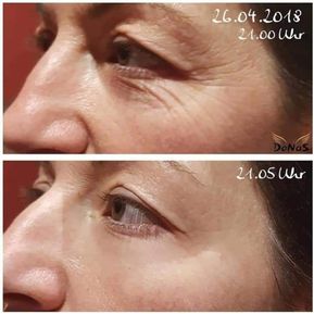 JM Derma Kosmetik_Fadenlifting ohne Nadeln